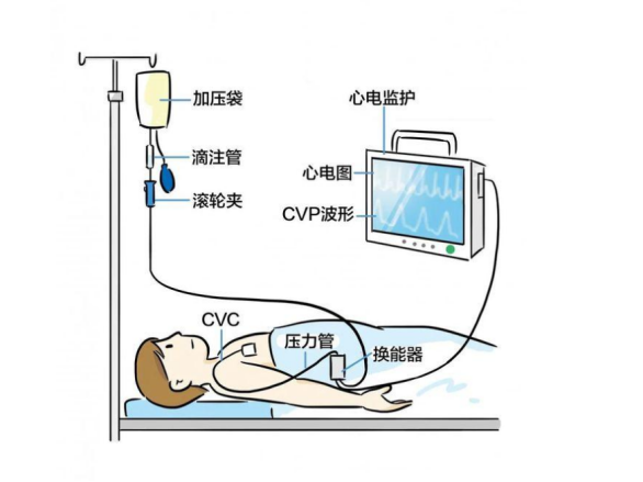 为什么医患偏爱中心静脉导管?