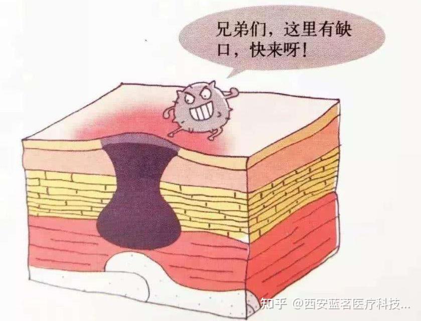 医学科普:压力性损伤/压疮(褥疮) - 知乎