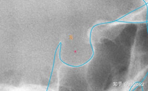 口腔 / 我和口腔科的故事(8): 北大口腔正畸篇-X线头影测量图解 - 知乎