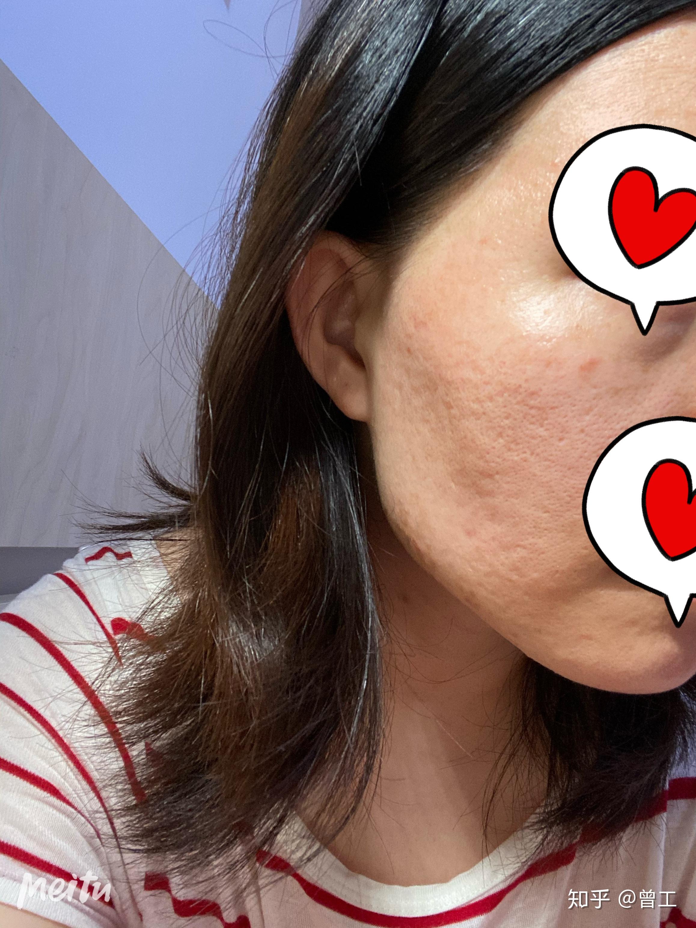 点阵激光治疗痘坑痘印毛孔粗大