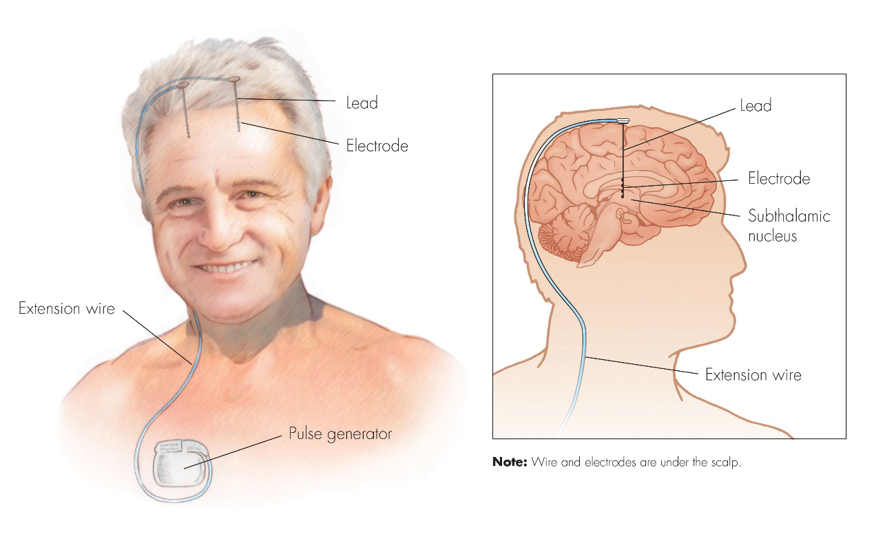 关于帕金森患者dbs手术时机选择的一些思考