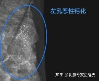 乳腺结节钙化灶,这 3 个危险信号,千万别忽视 - 知乎