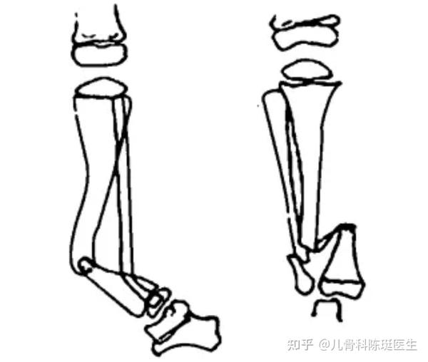 胫骨骨折走路一瘸一拐 脚骨折一年了走路还疼 骨折后怎么锻炼才不瘸