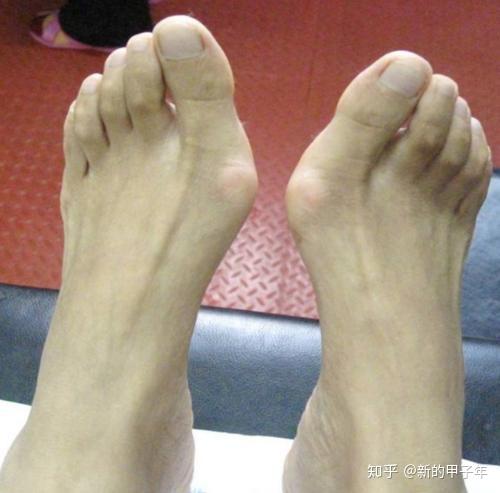 扰人的拇外翻让脚越来越丑如何根治呢
