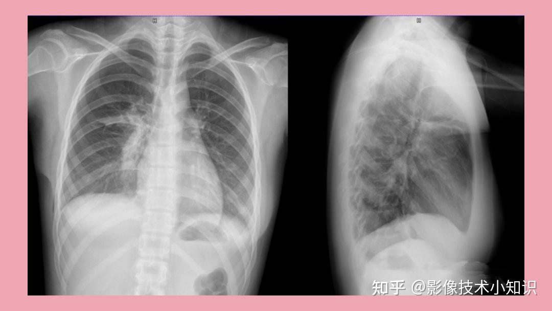 如何识别侧位胸片是左侧位还是右侧位 - 知乎