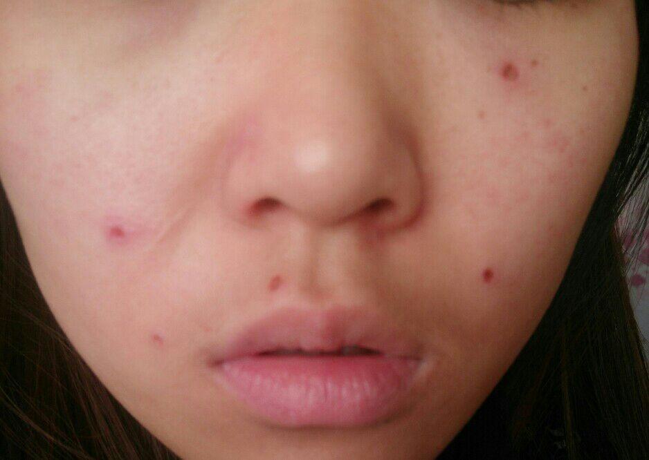 电灼烧点痣 - 知乎