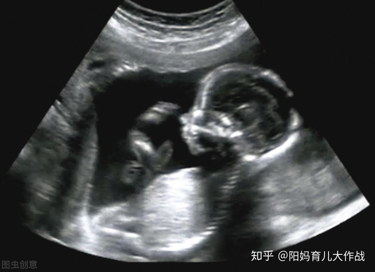 妊娠中期瘢痕子宫不全破裂修补术后妊娠至34周分娩1例