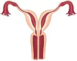 子宮 重複 子宮奇形とは？ 女性の5％ほどにみられる病気