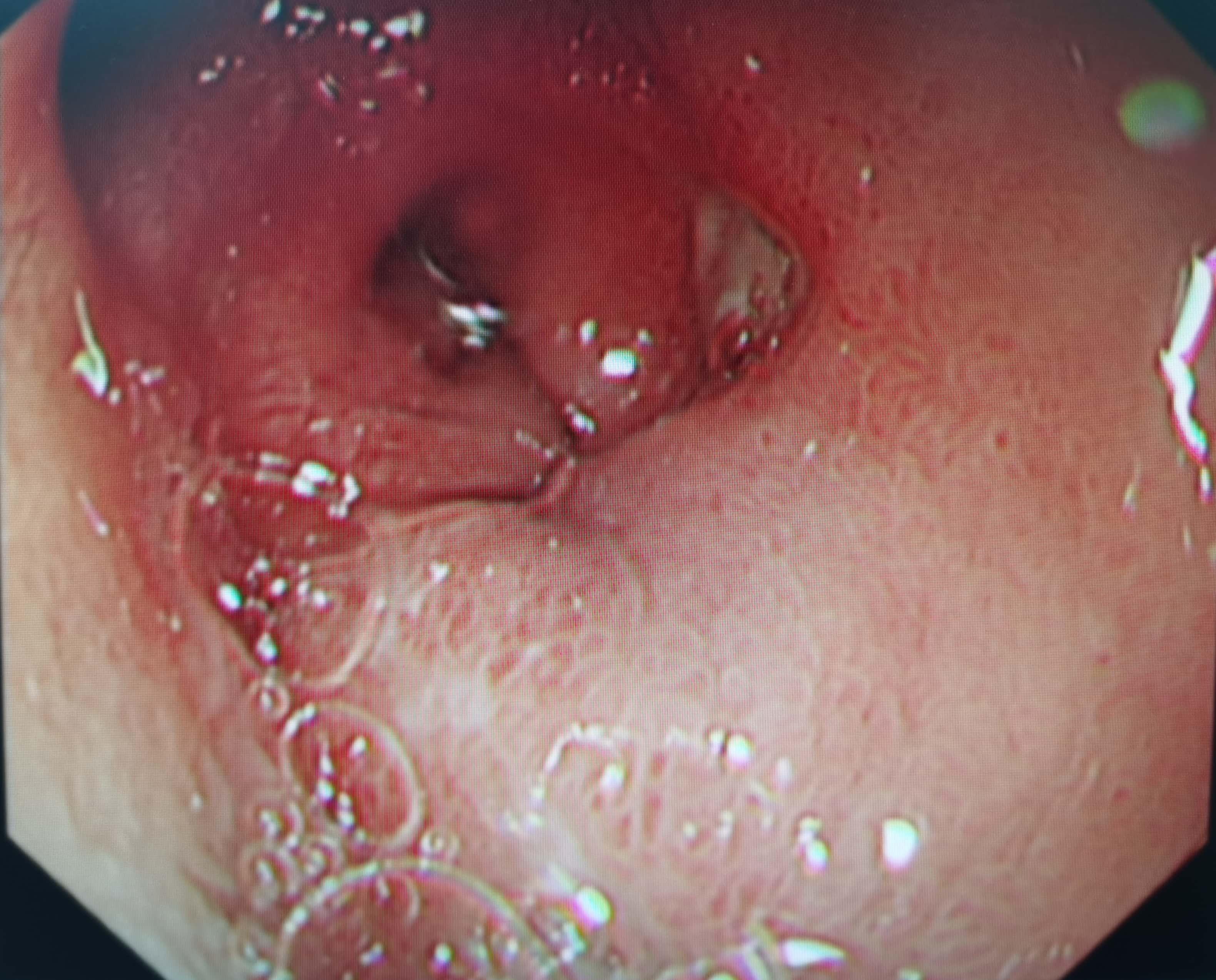十二指肠球部"假性憩室"-如果内镜医生不注意,会穿孔的存在