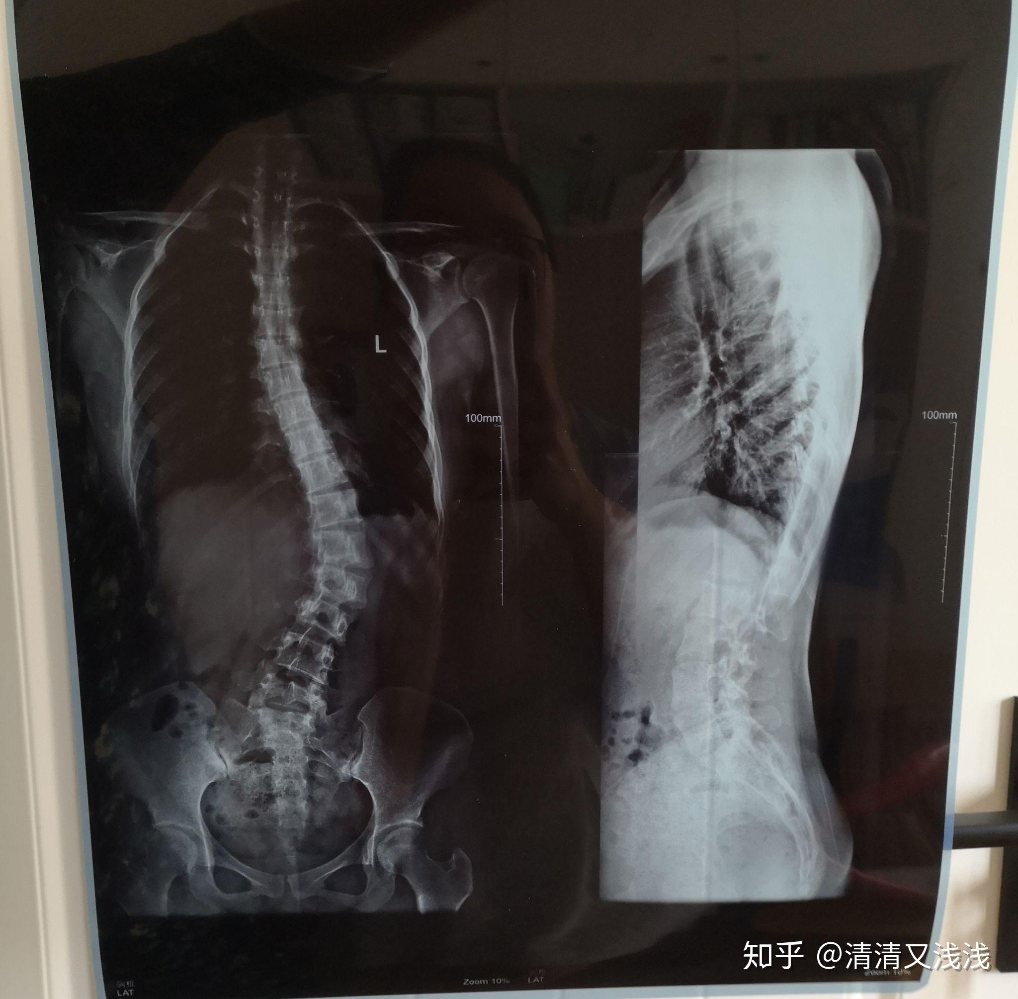 脊柱侧弯患者自述