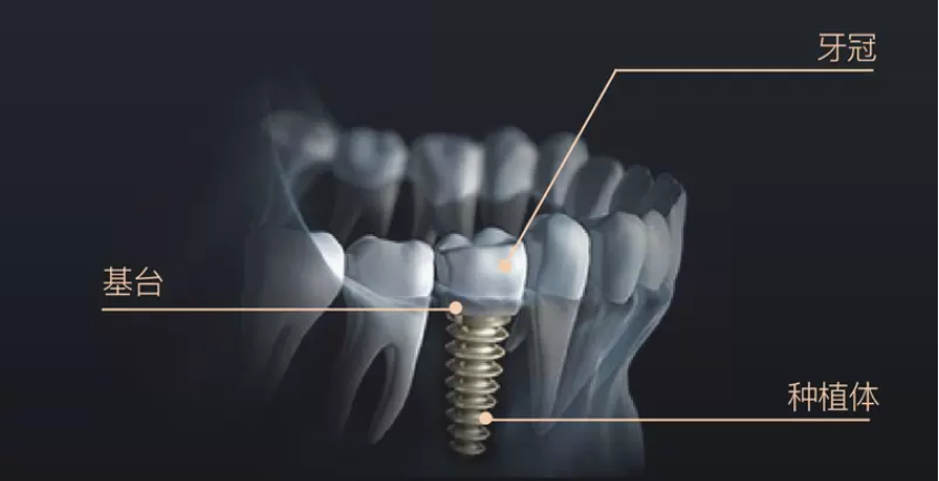 通過外科手術將種植體植入牙槽骨,作為人工牙根,然後以此為基礎修復