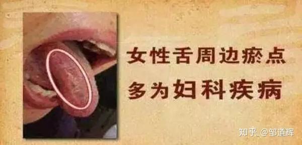 舌诊 舌头是人体自带的体检表 知乎