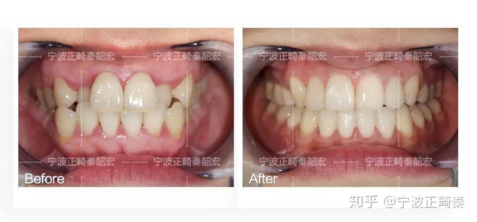 自洁作用好,不易细菌入侵03支撑口角,颜值担当虎牙上方的骨头叫尖牙