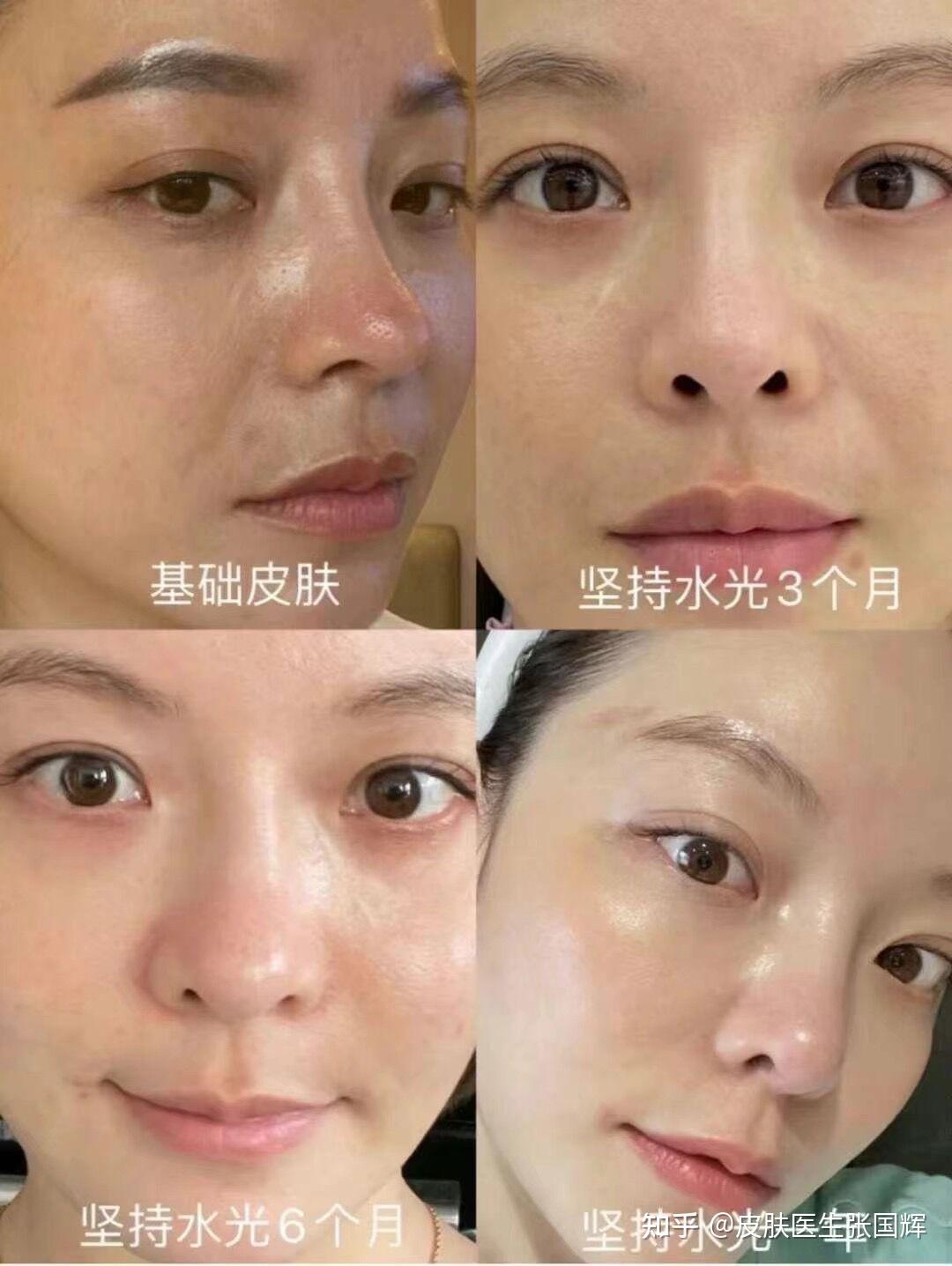 打水光针术后反黑反干正常吗如何避免水光针术后反黑反干问题