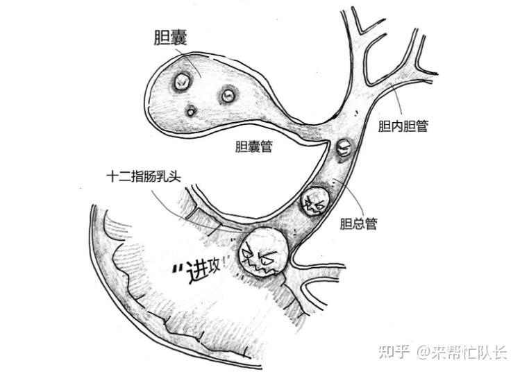 胆管在哪里？急性胆管炎和慢性胆管炎有什么区别？ - 知乎