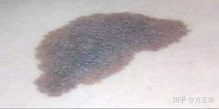 太田痣治疗后怎么疗养注意事项都有哪些