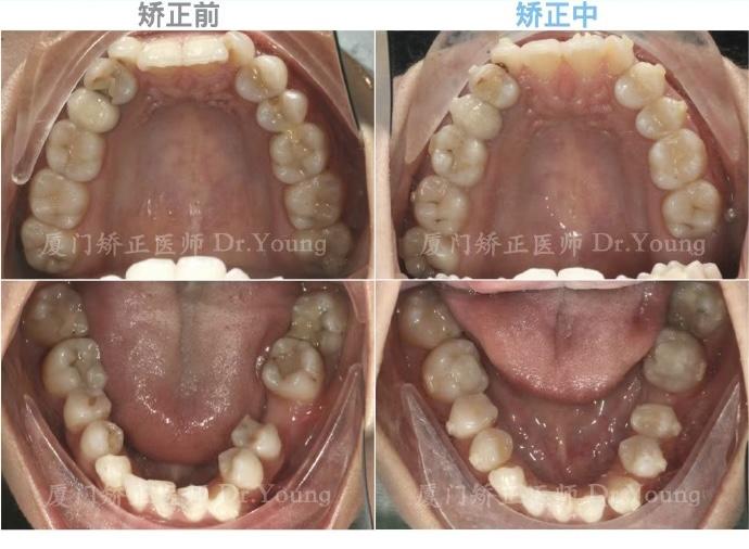 78正畸方案:上牙列通過磨牙遠移 前牙唇傾,下牙列利用缺牙間隙排齊