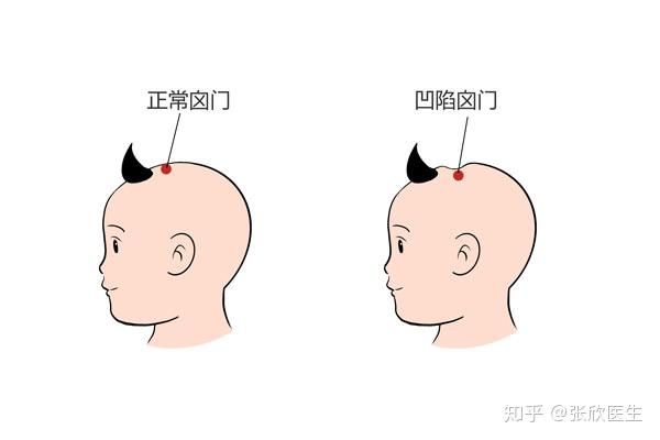 如何判断宝宝的囟门是否凹陷 - 知乎