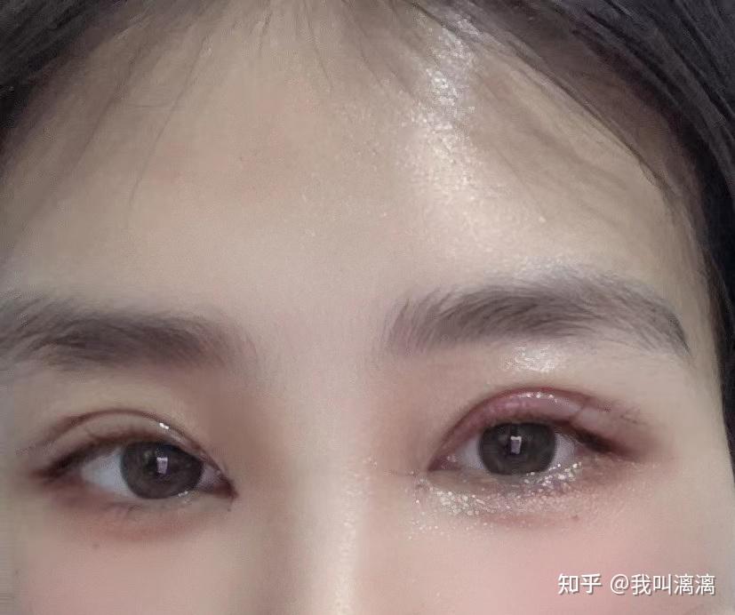 杭州双眼皮案例分享,成功上岸;医生功课