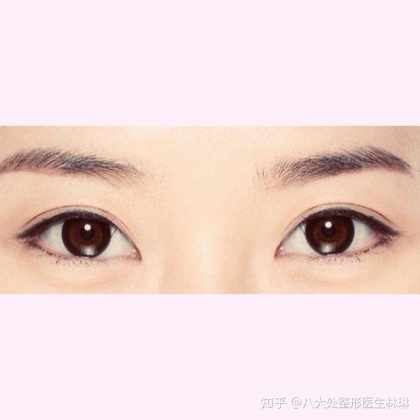 科普什么是平行双眼皮
