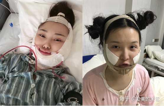下颌角削骨手术有什么风险要准备多少钱变化能有多大后遗症有哪些想做