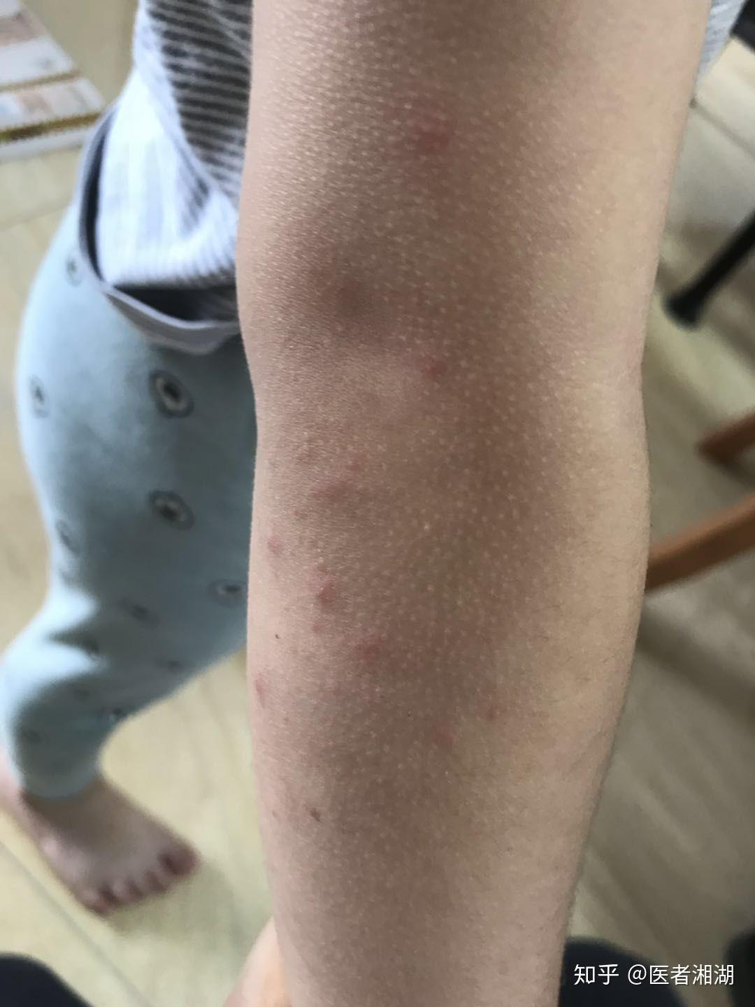 手足口不用惊慌可以中药泡浴