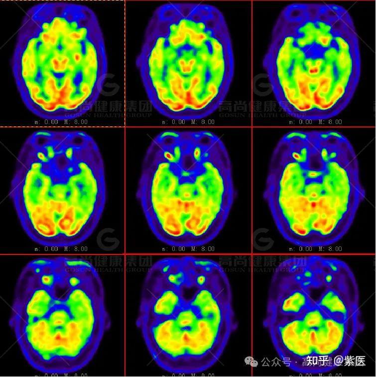 学术荟萃系列专题 | PET脑成像在阿尔茨海默病的应用价值 - 知乎
