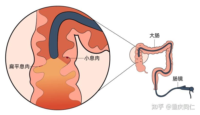 肠镜怎么做痛苦吗时间多久