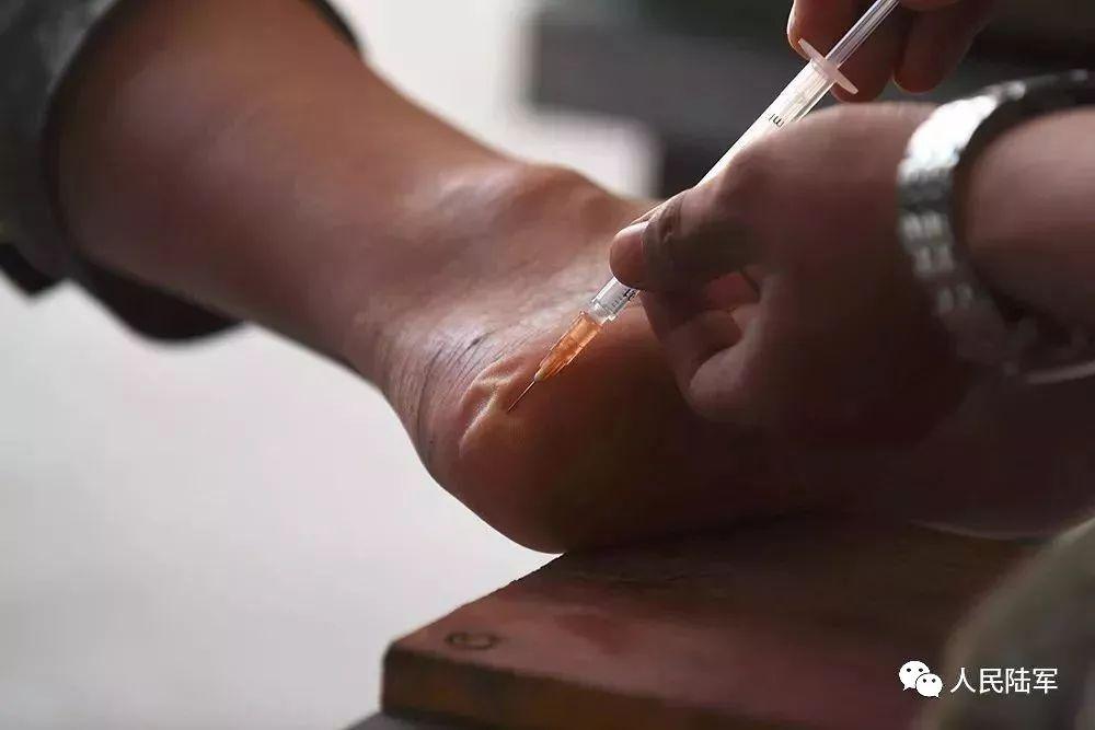 一个水泡能抽出一针管积液▲官兵脚掌被磨破虽然没有收容车但官兵们