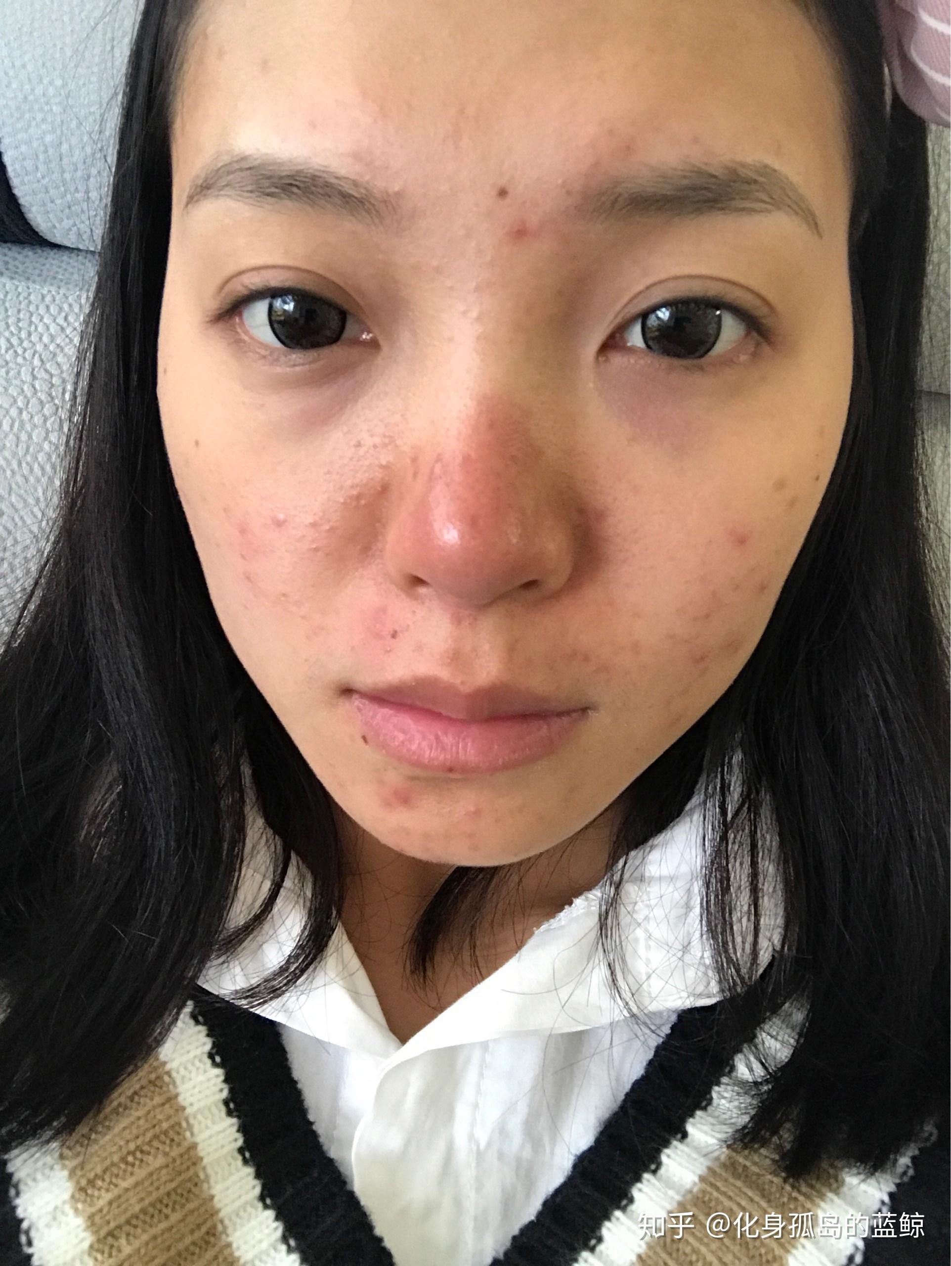 怎么看待五官漂亮但是皮肤差的女性