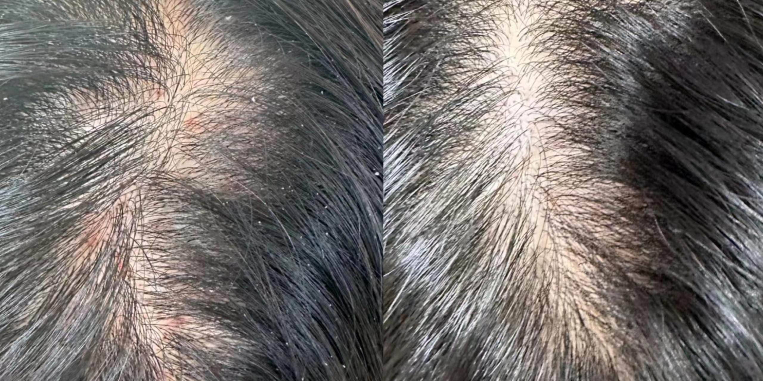 从医学角度来看,为什么头皮泛红长痘一定要抑菌除螨双管齐下? - 知乎
