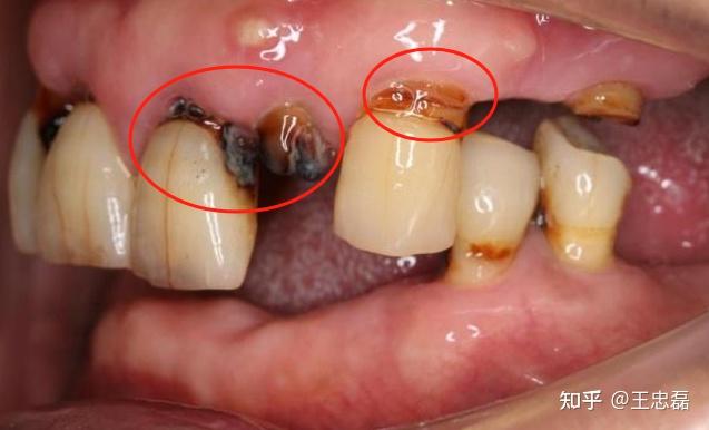 老年人最容易出现的4种牙齿问题,提前知晓提前预防! 