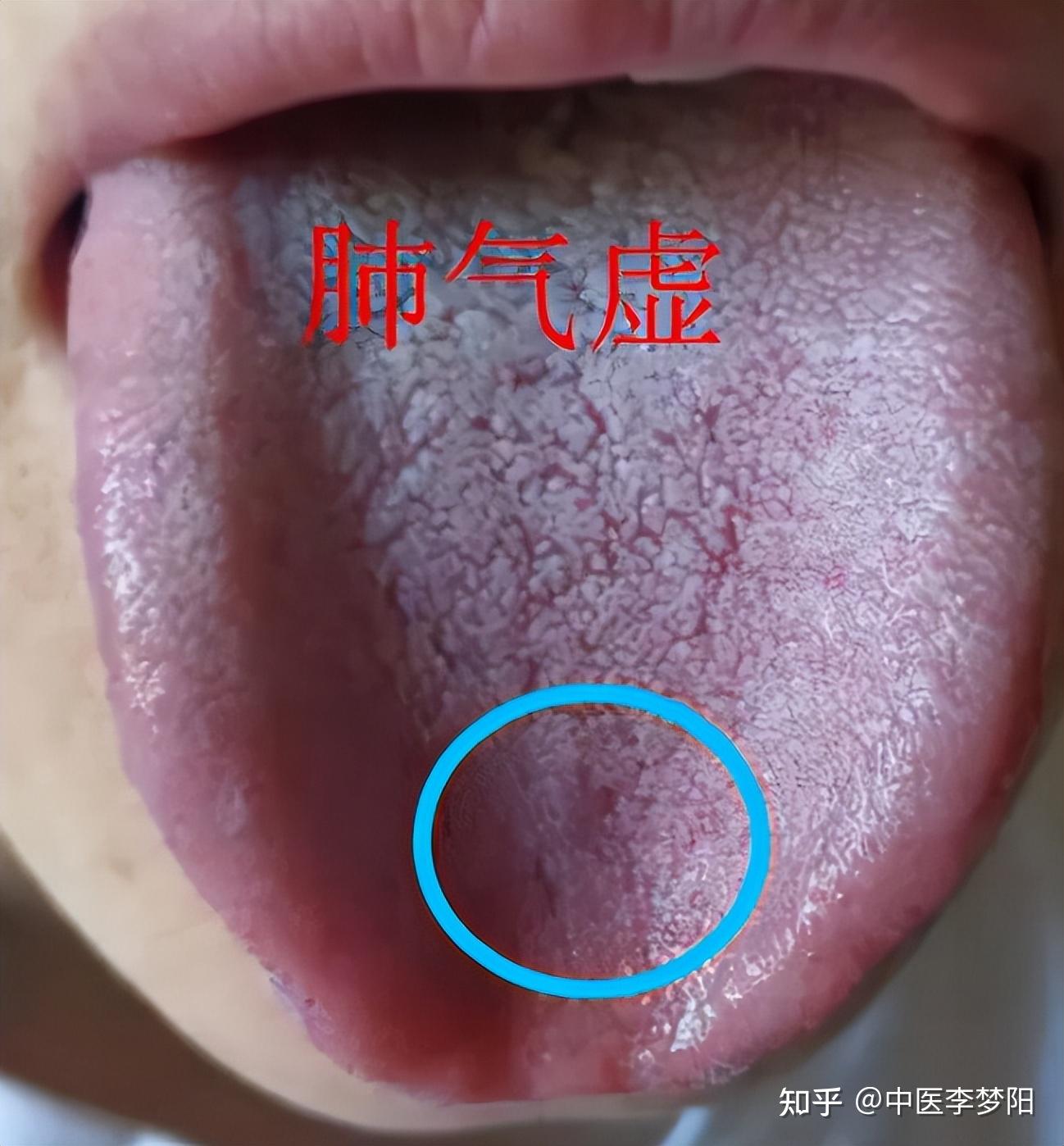 气虚怎么补?通过舌象告诉你如何精准参考中成药,学会不走弯路 - 知乎