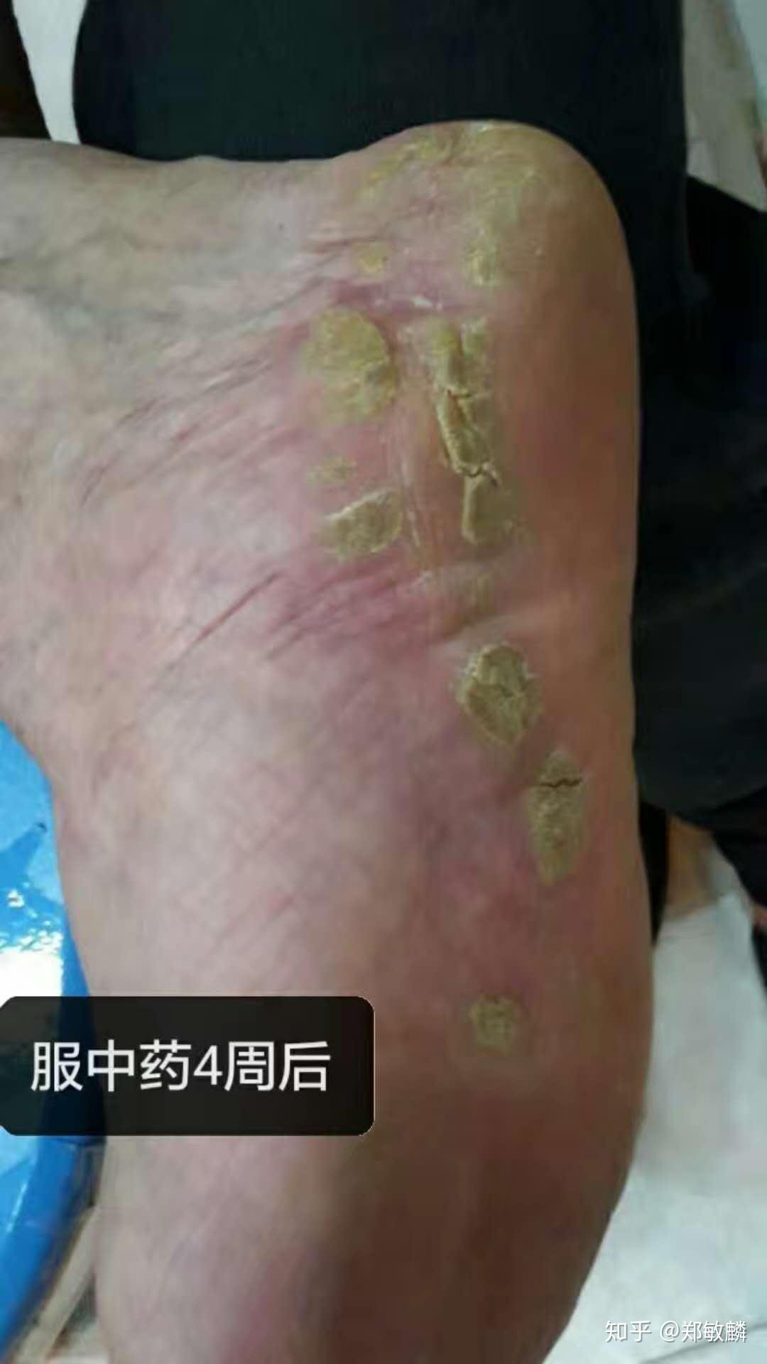 郑敏麟医案皮肤过度角质化案