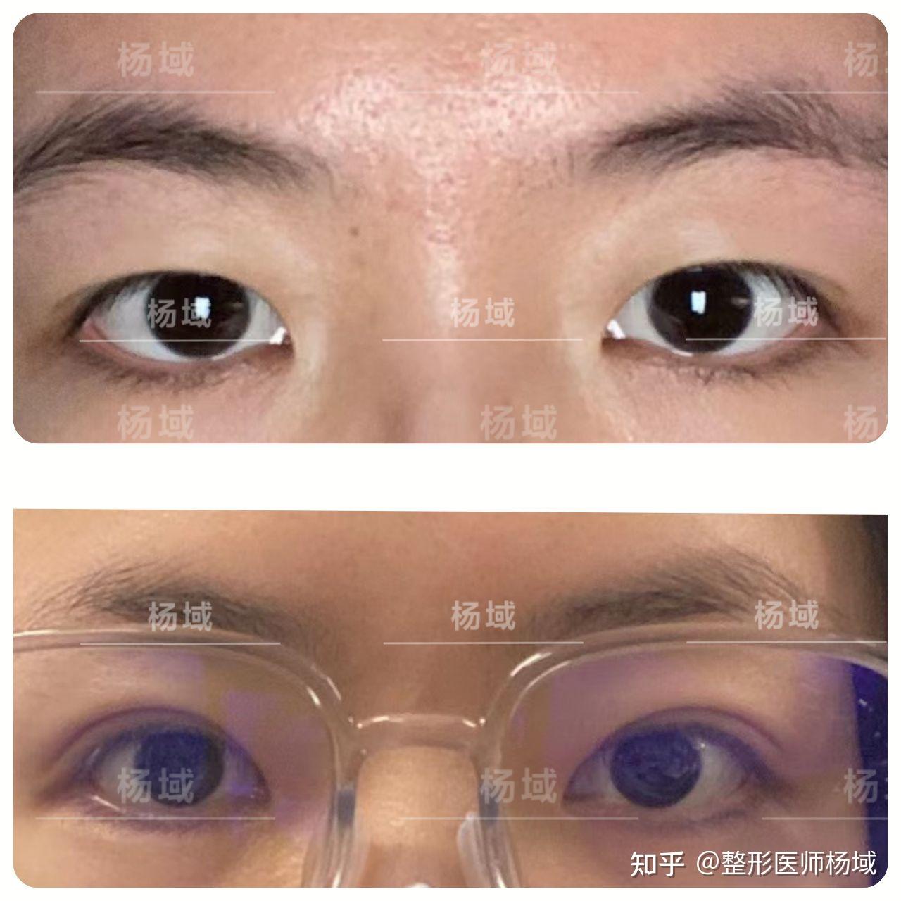 双眼皮为什么会比单眼皮好看? - 知乎