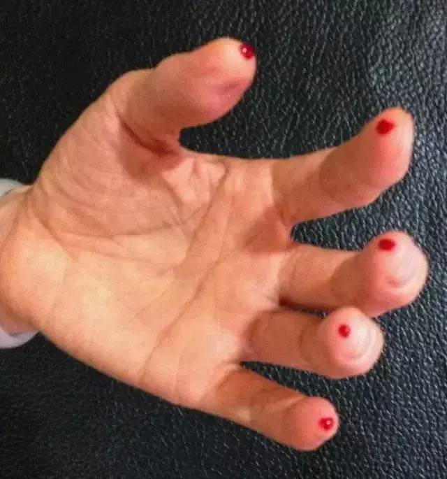 肝火旺手指放血位置图片