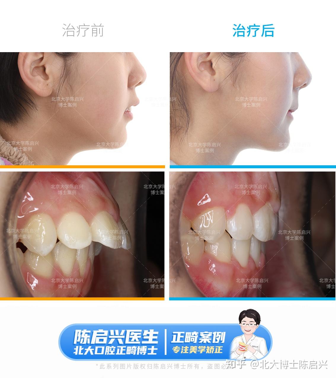 Ⅲ度深覆盖 门牙缝大矫正案例