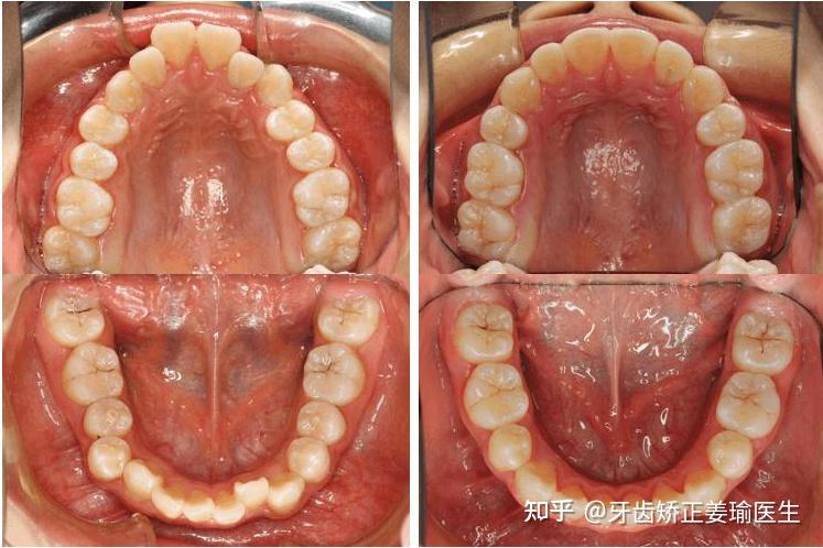 怎么判断深覆盖是牙性的还是骨性的啊?