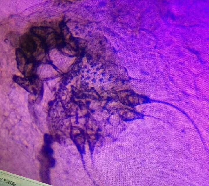 疥虫是怎么回事,最快的治疗方案是什么?