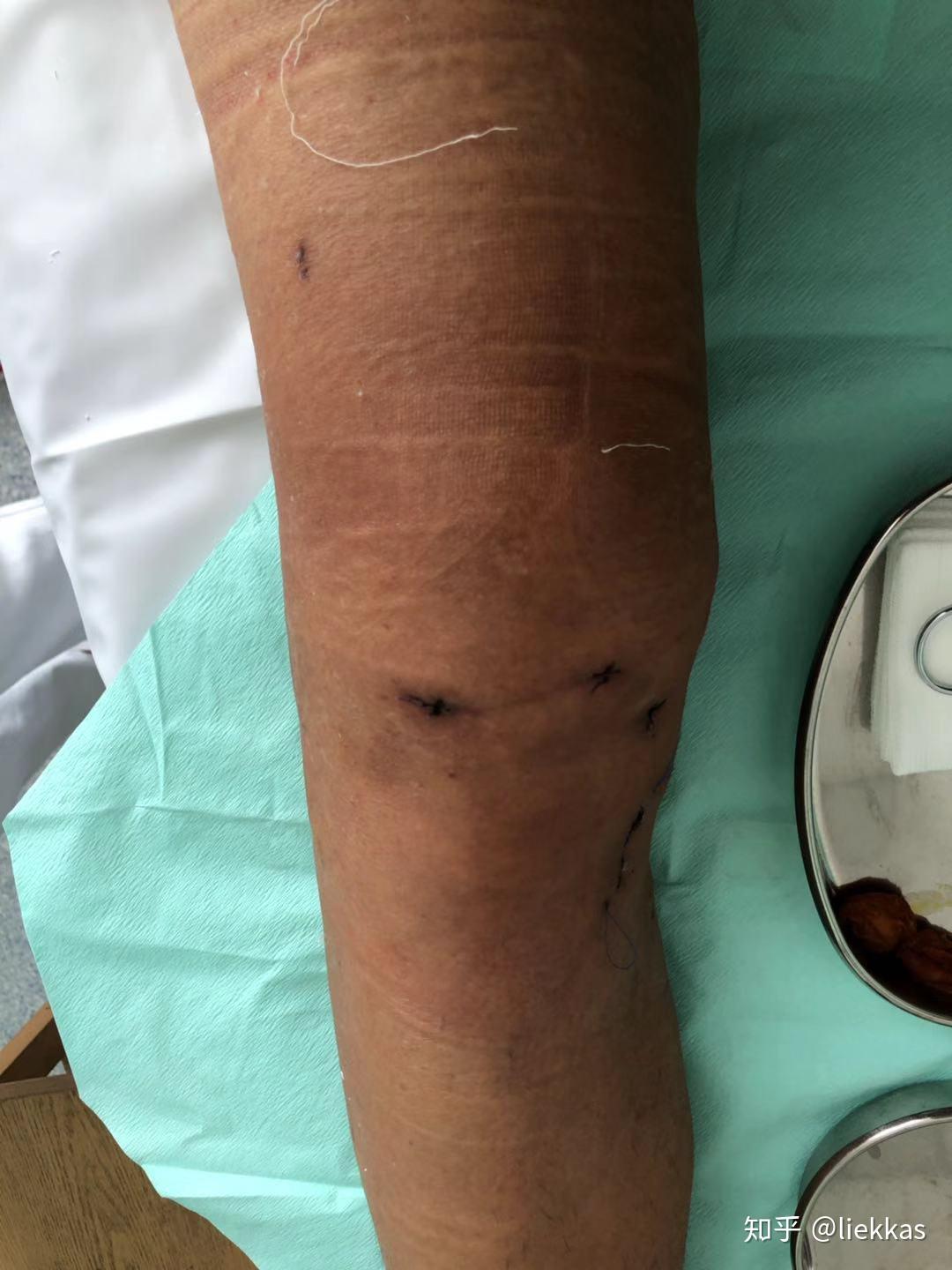 前十字韧带又称前叉重建及复建体会