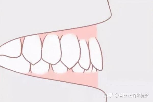如果你不做的话,等年纪大的时候,一定会出现咬合的创伤,牙齿会越来越