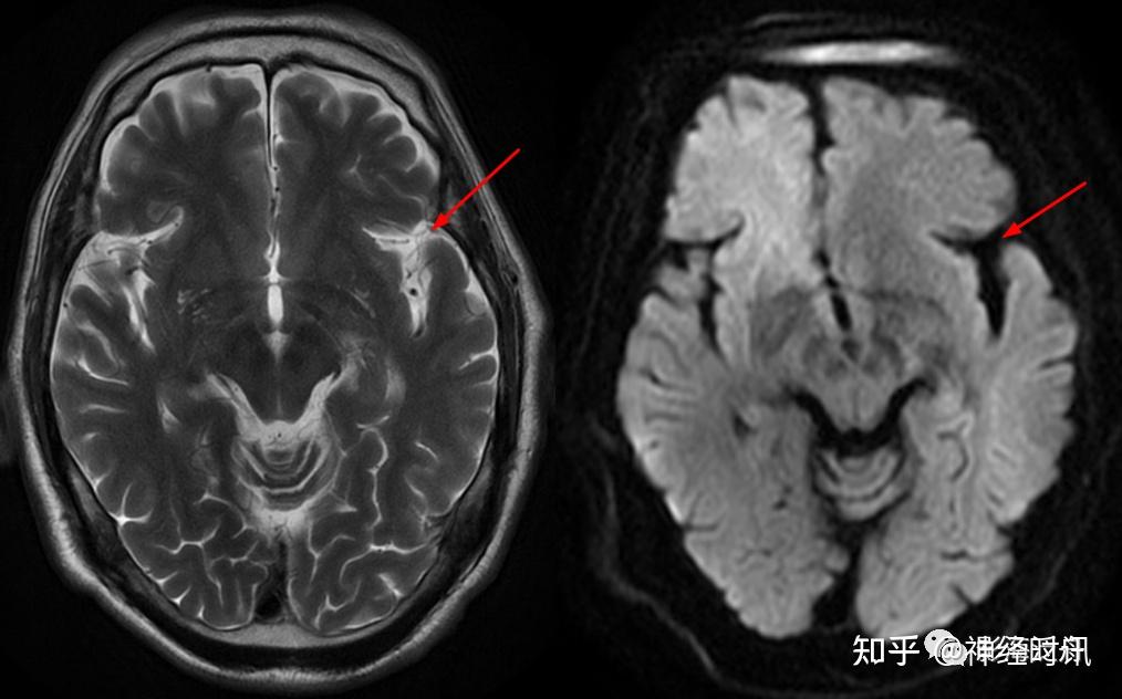 不過仔細觀察,可見左側側裂池要明顯寬於對側,是否為異常改變?