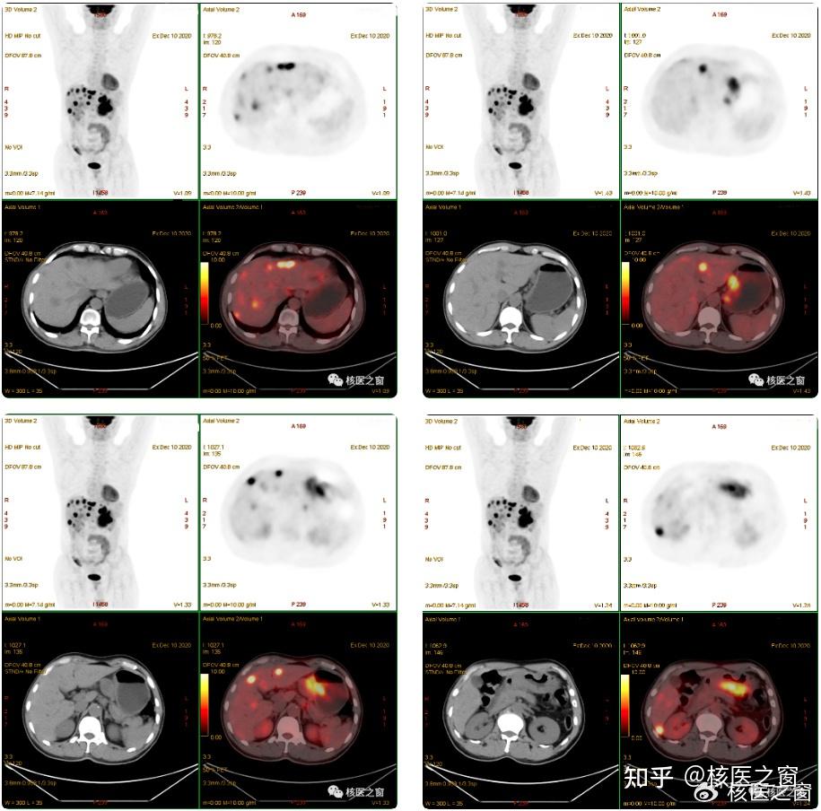 PET/CT在胃癌分期中的应用 - 知乎
