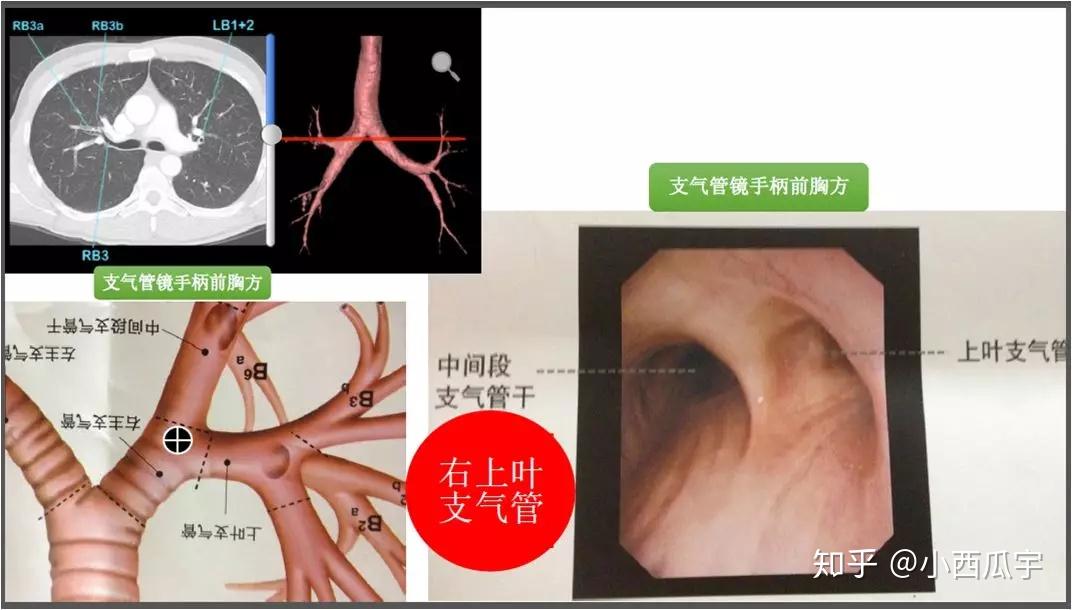 支氣管樹命名學習