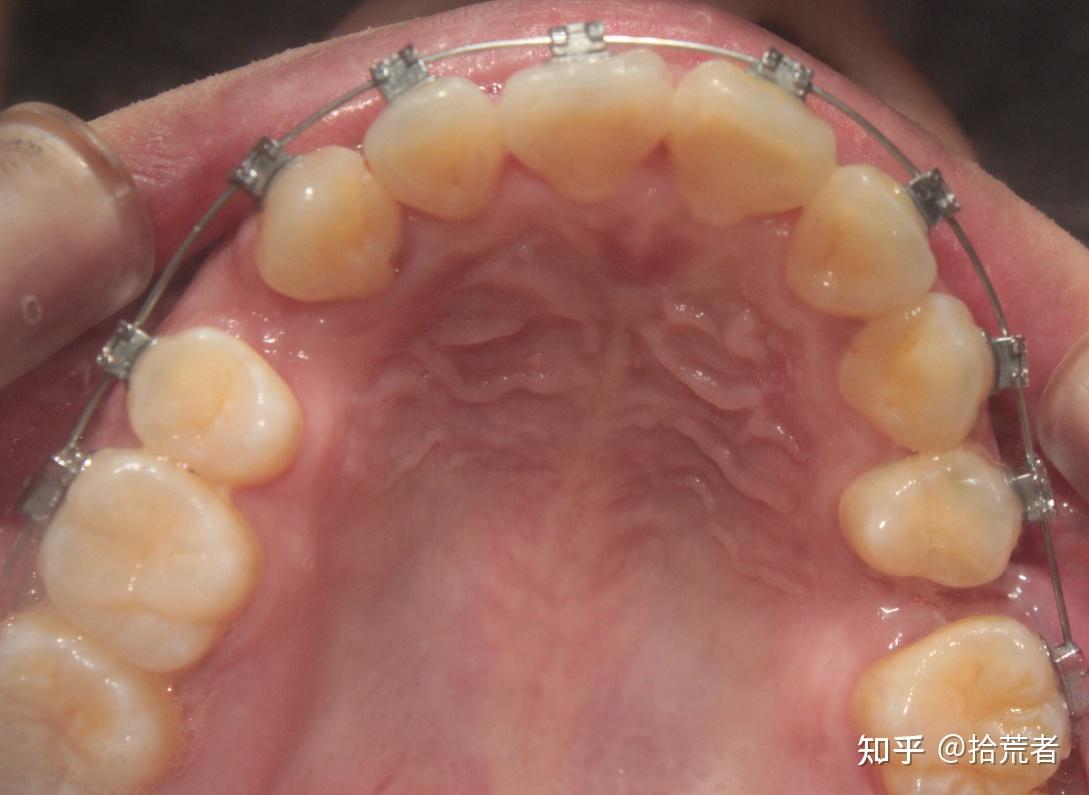 短短90天牙齿变化惊人