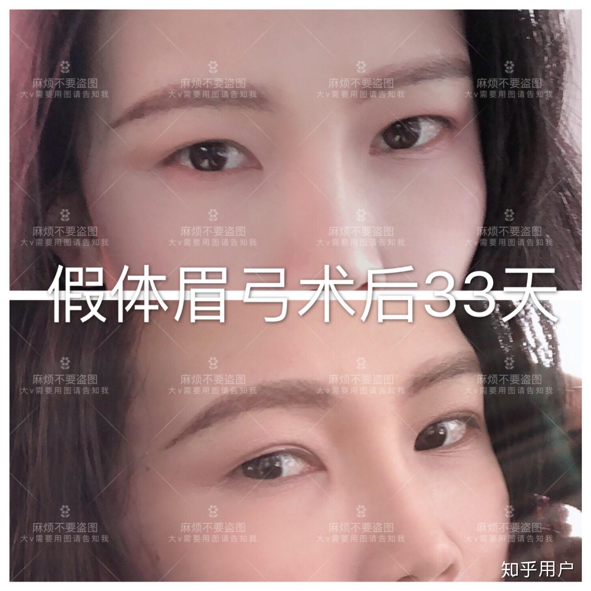 做膨体假体隆眉弓真的会下移吗