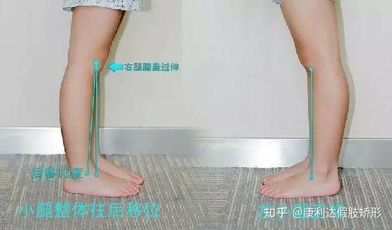 "膝反张"原因有三:(1)膝关节本身骨性变化,致膝关节位置不正常;(2)