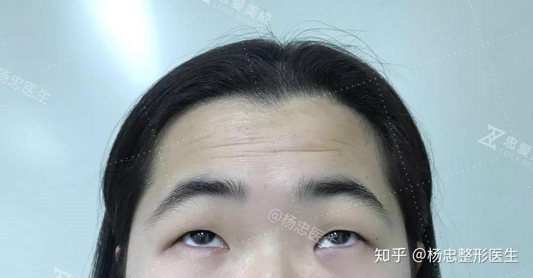 真人案例小眼睛是病这些事情你得知道