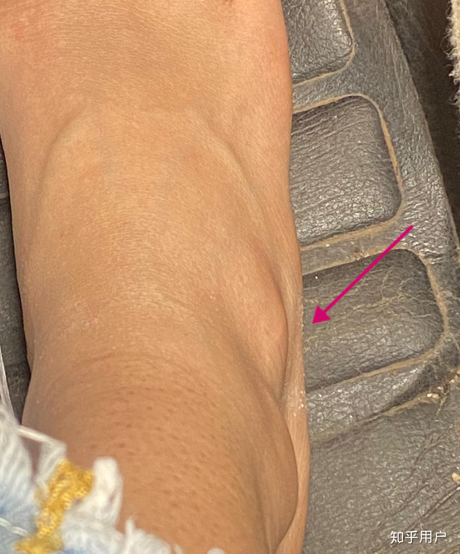 脚扭伤一年后未消肿 脚背有像骨头一样的硬块 有高手知道怎么回事吗?