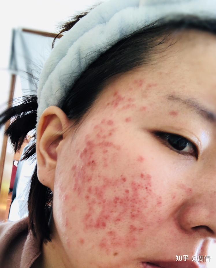 严重痘肌医美分享点阵激光光子热玛吉皮秒